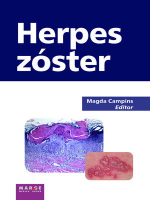 cover image of Herpes Zóster